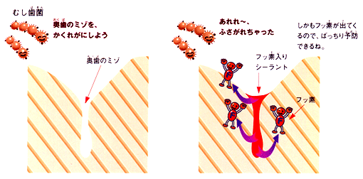 シーラント予防填塞